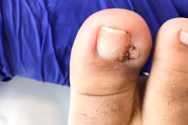 Uña Encarnada (Onicocriptosis)